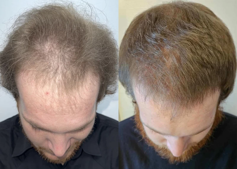 Patient p621 hair transplant before and after tilt view
