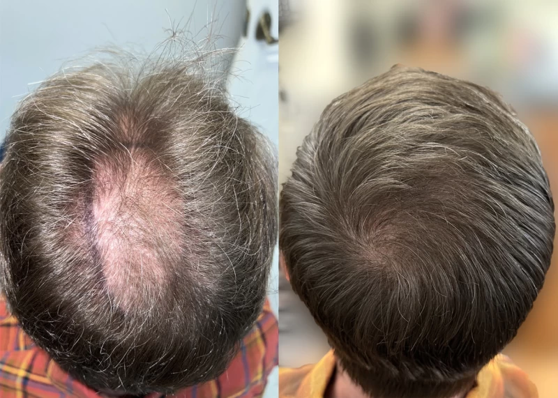 Patient p622 hair transplant before and after crown view