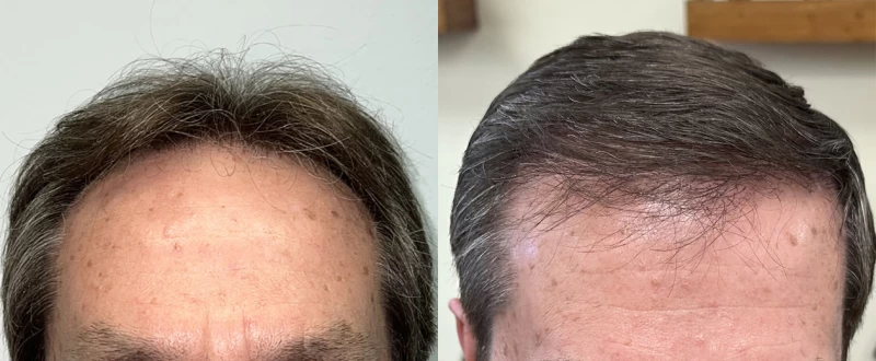Patient 622 Hair Transplant Before and After