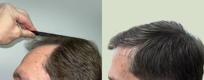 Patient p622 hair transplant before and after left view