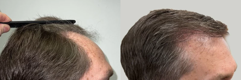 Patient p622 hair transplant before and after right view