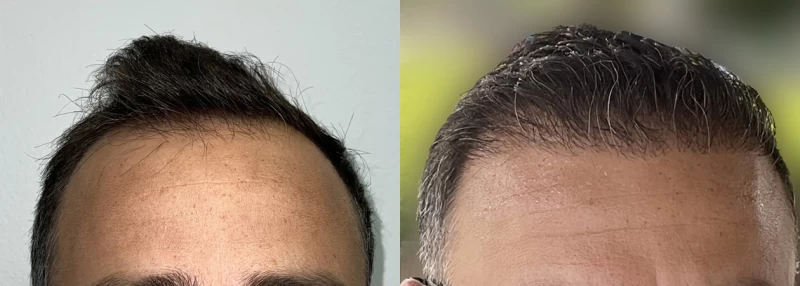 Patient 623 Hair Transplant Before and After