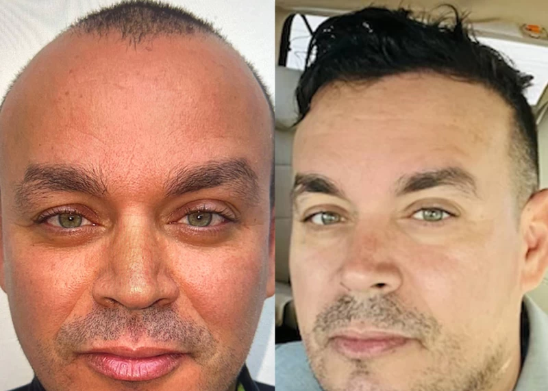 Patient 624 Hair Transplant Before and After