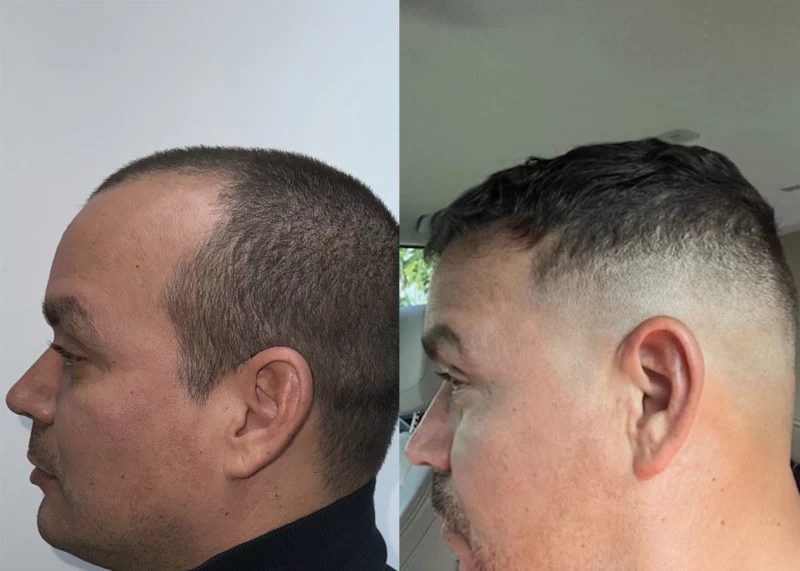 Patient p624 hair transplant before and after left view