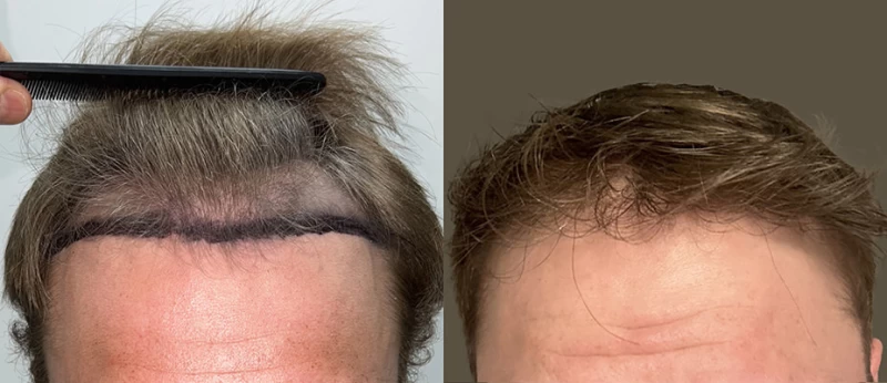Patient 625 Hair Transplant Before and After