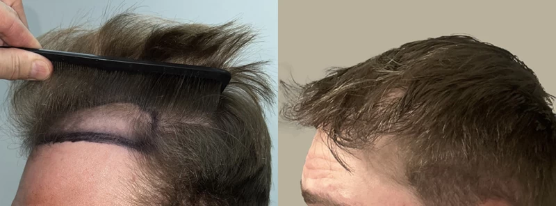 Patient p625 hair transplant before and after left view