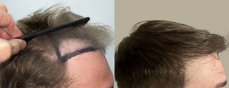 Patient p625 hair transplant before and after right view