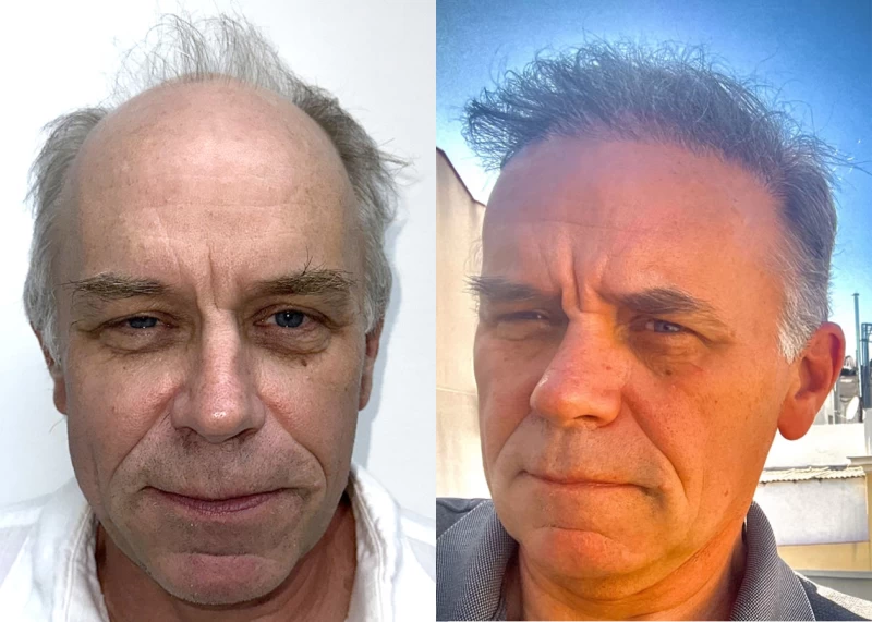 Patient 626 Hair Transplant Before and After