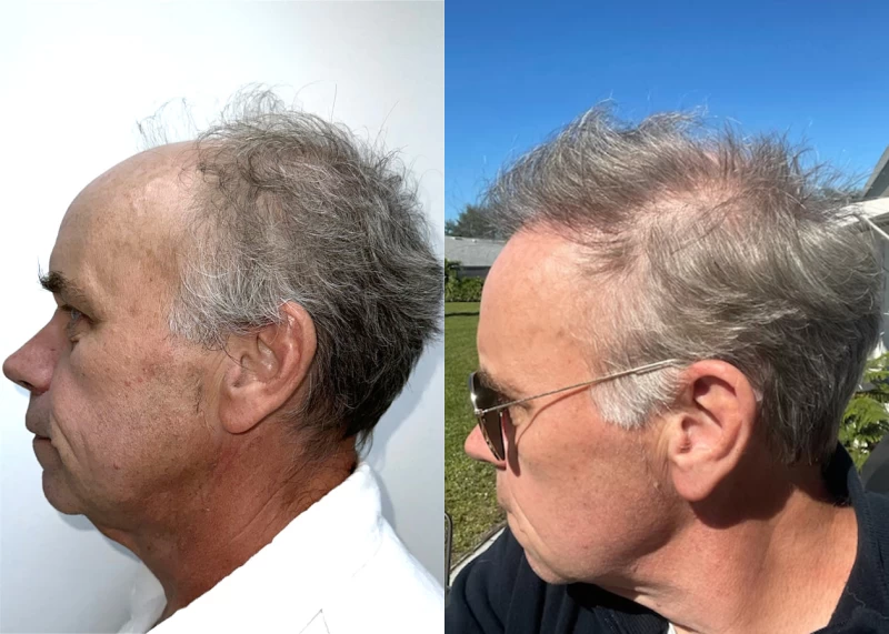 Patient p626 hair transplant before and after left view