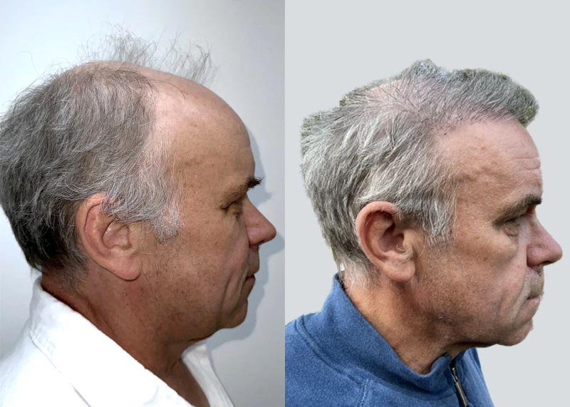 Patient p626 hair transplant before and after right view