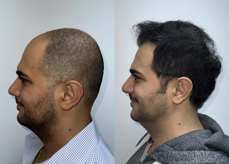 Patient p627 hair transplant before and after left view