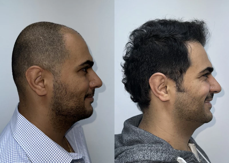 Patient p627 hair transplant before and after right view