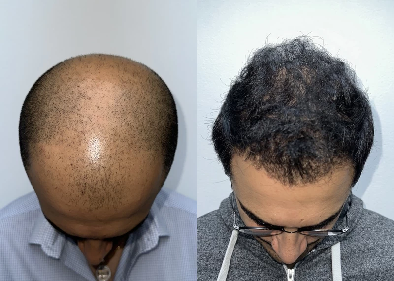 Patient p627 hair transplant before and after tilt view
