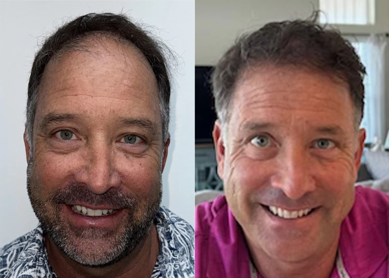 Patient 628 Hair Transplant Before and After