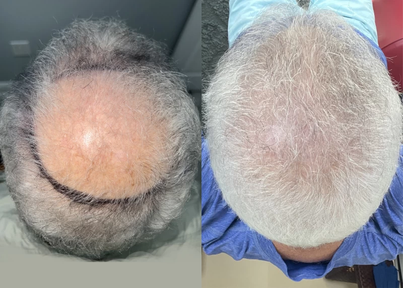 Patient p629 hair transplant before and after crown view