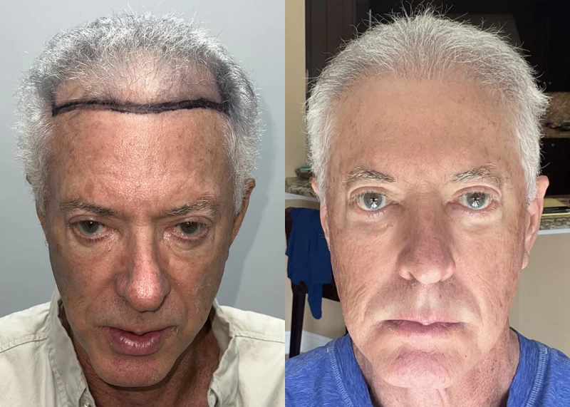 Jimmy Hair Transplant Before and After