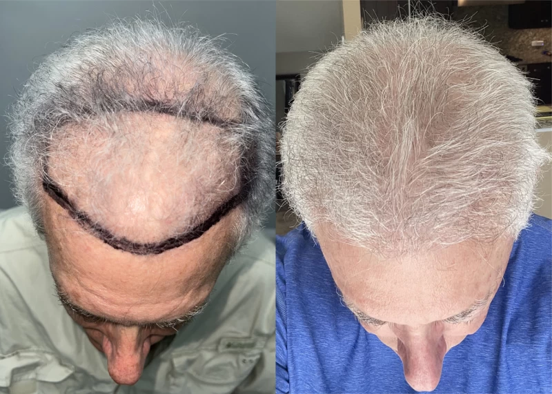 Patient p629 hair transplant before and after tilt view