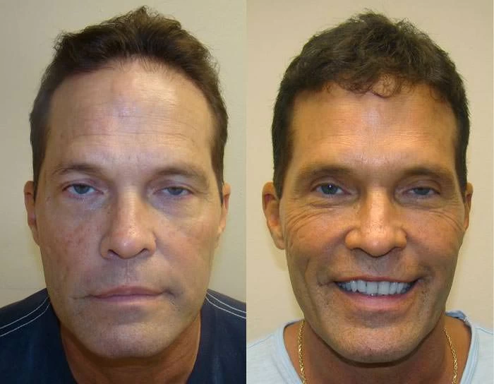 Larry Hair Transplant Before and After