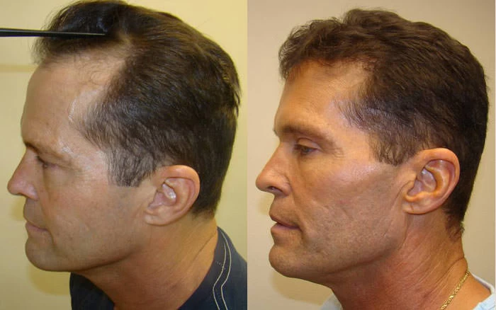 Patient p62 hair transplant before and after left view