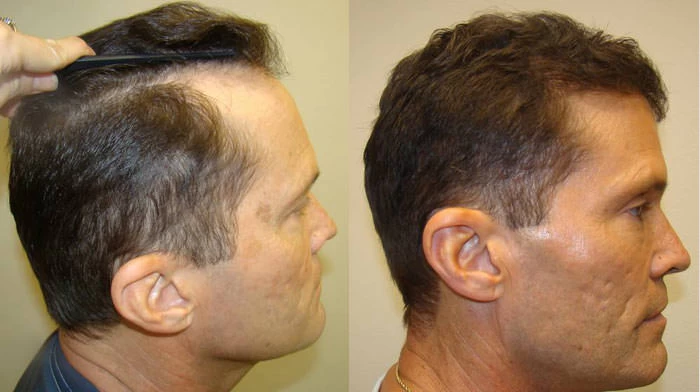 Patient p62 hair transplant before and after right view
