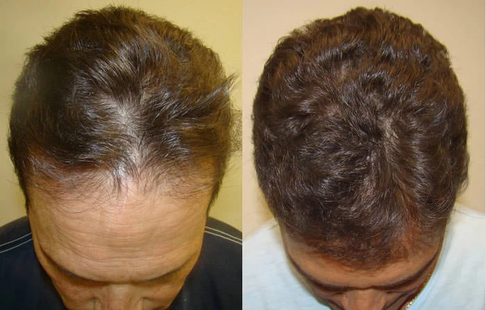 Patient p62 hair transplant before and after tilt view