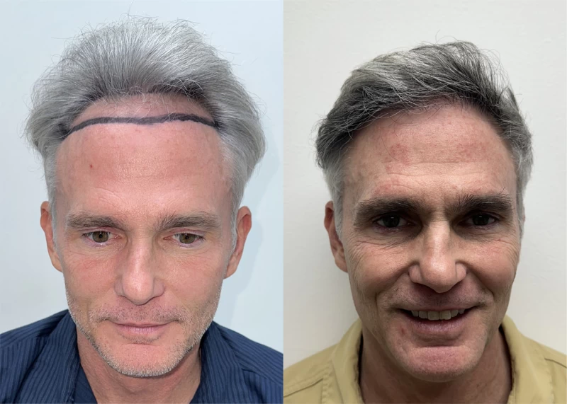 James  Hair Transplant Before and After