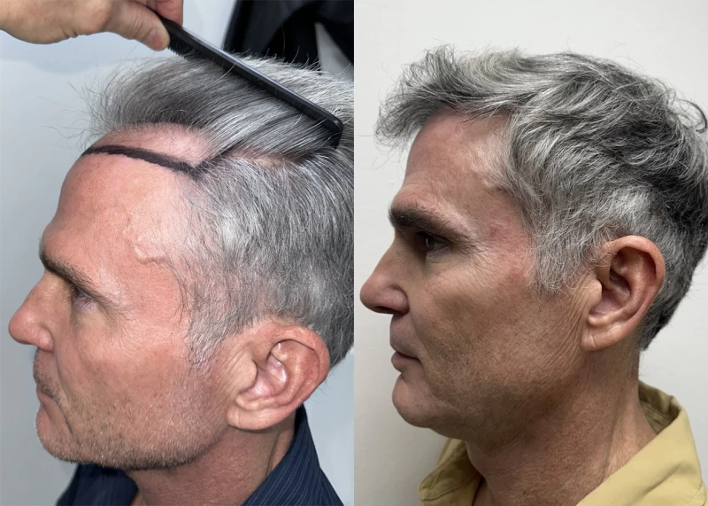 Patient p630 hair transplant before and after left view