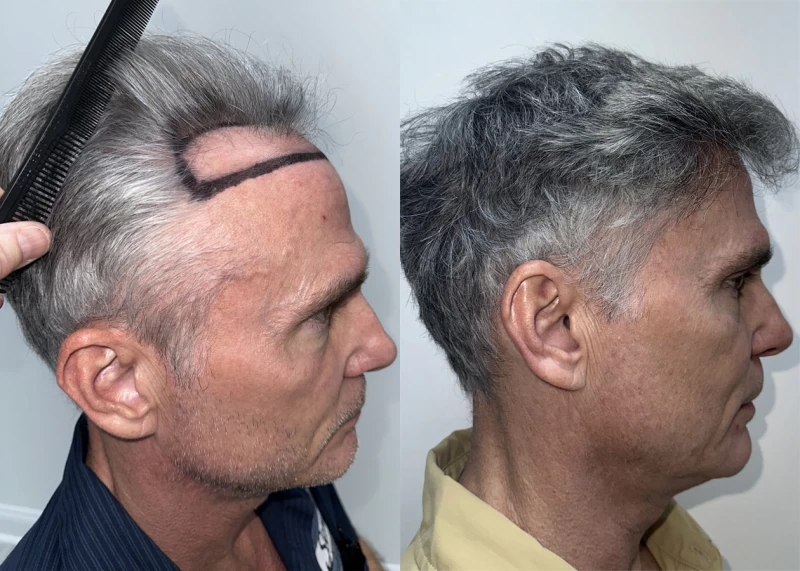 Patient p630 hair transplant before and after right view