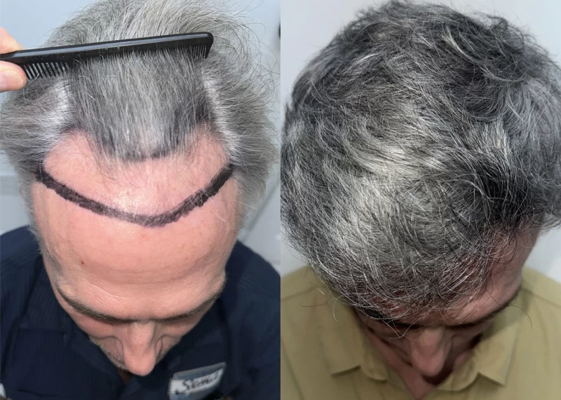Patient p630 hair transplant before and after tilt view