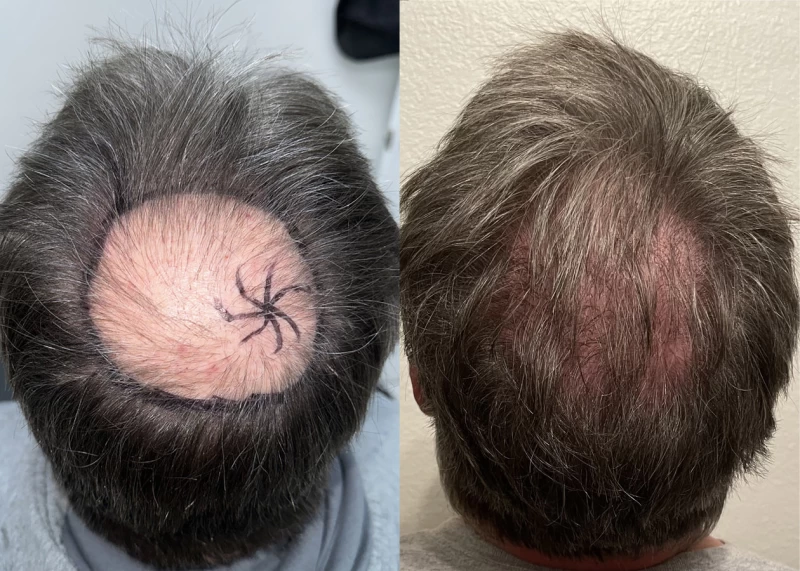 Patient p631 hair transplant before and after crown view