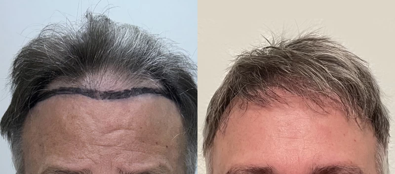 Patient 631 Hair Transplant Before and After