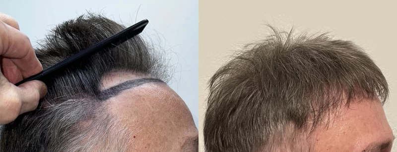 Patient p631 hair transplant before and after right view