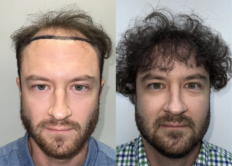 Mark Hair Transplant Before and After