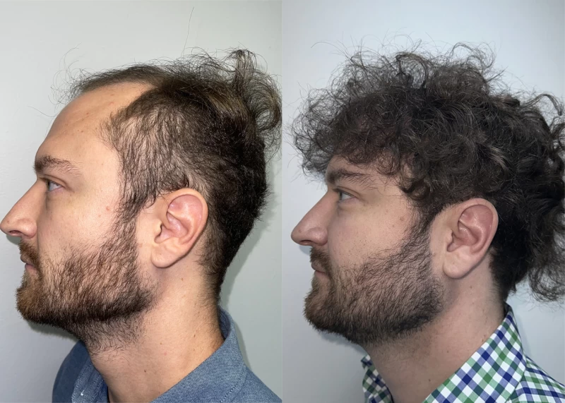 Patient p632 hair transplant before and after left view