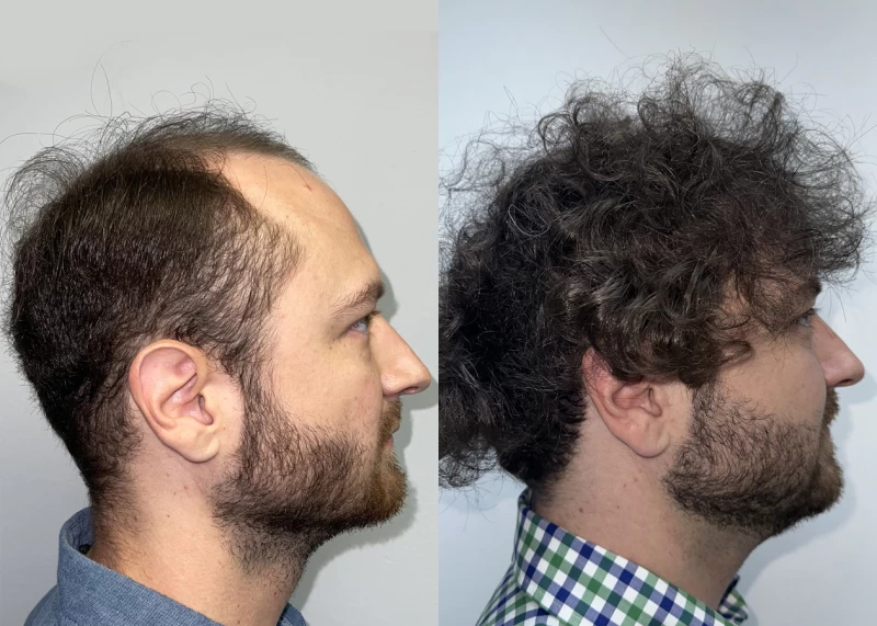 Patient p632 hair transplant before and after right view
