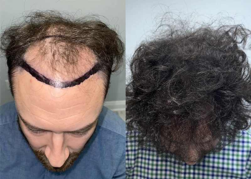 Patient p632 hair transplant before and after tilt view