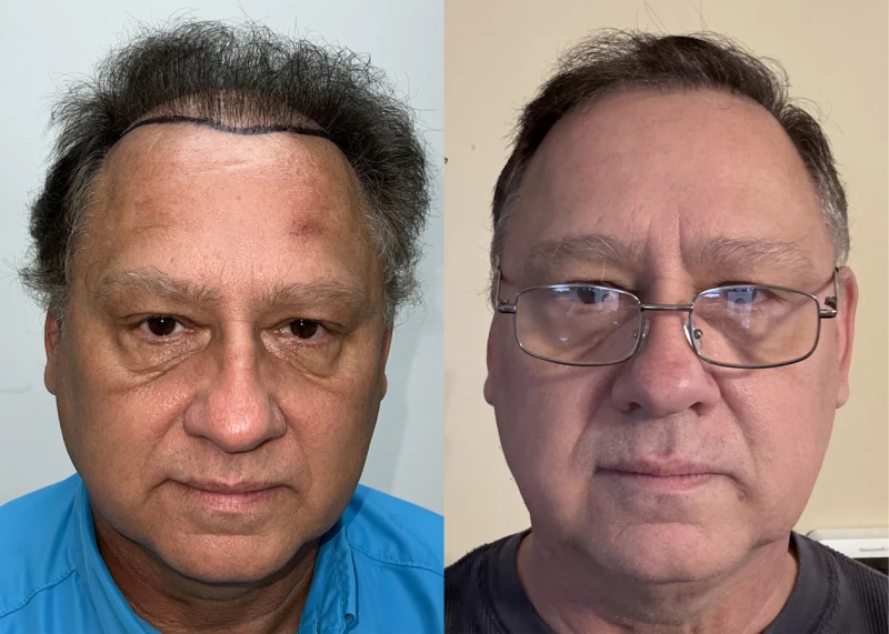Patient 633 Hair Transplant Before and After