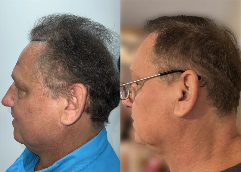Patient p633 hair transplant before and after left view