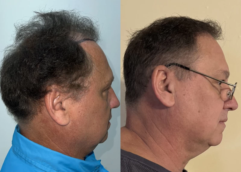 Patient p633 hair transplant before and after right view