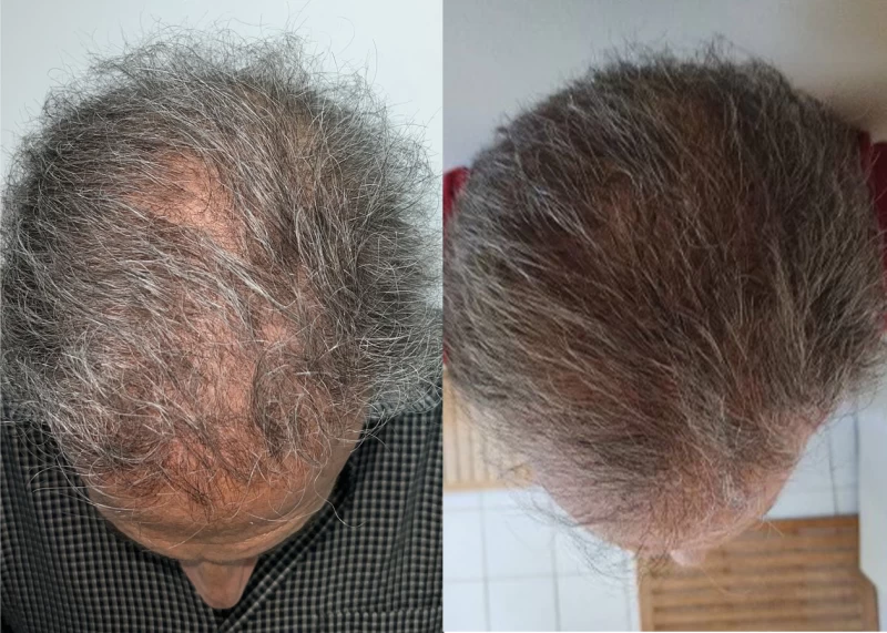 Patient 634 Hair Transplant Before and After