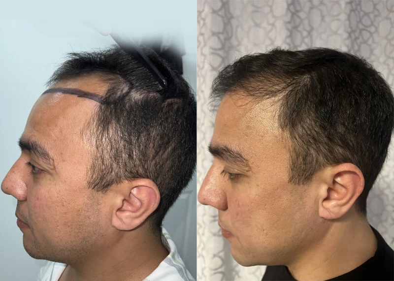 Patient p635 hair transplant before and after left view