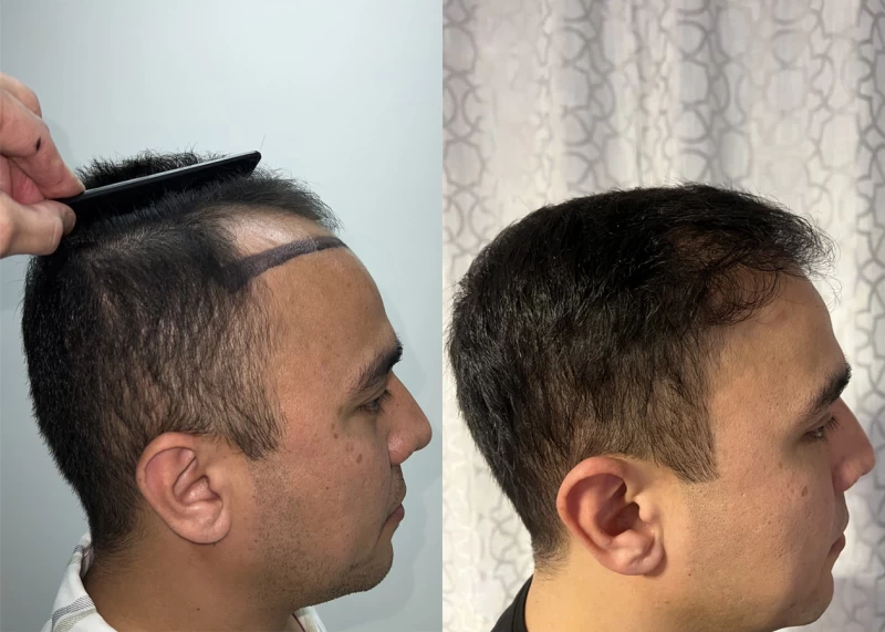 Patient p635 hair transplant before and after right view