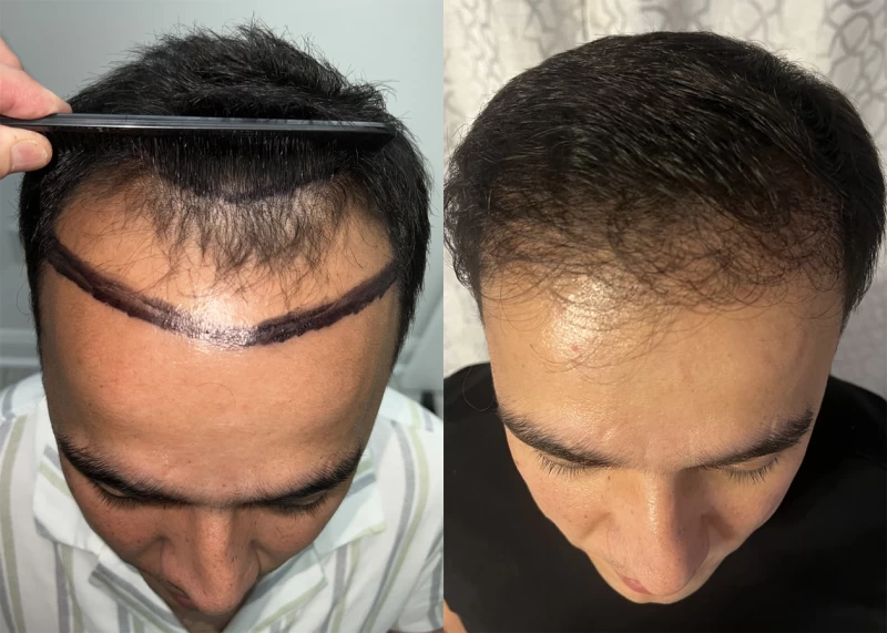 Patient 635 Hair Transplant Before and After