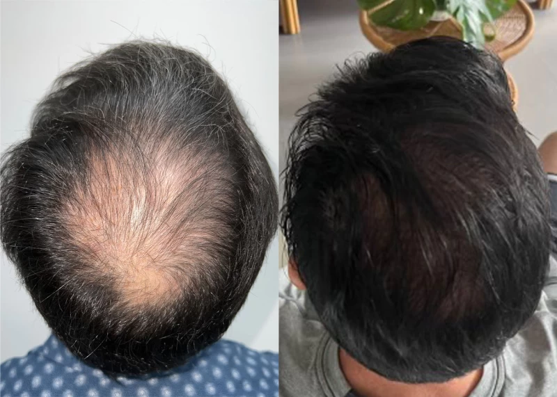 Patient p636 hair transplant before and after crown view