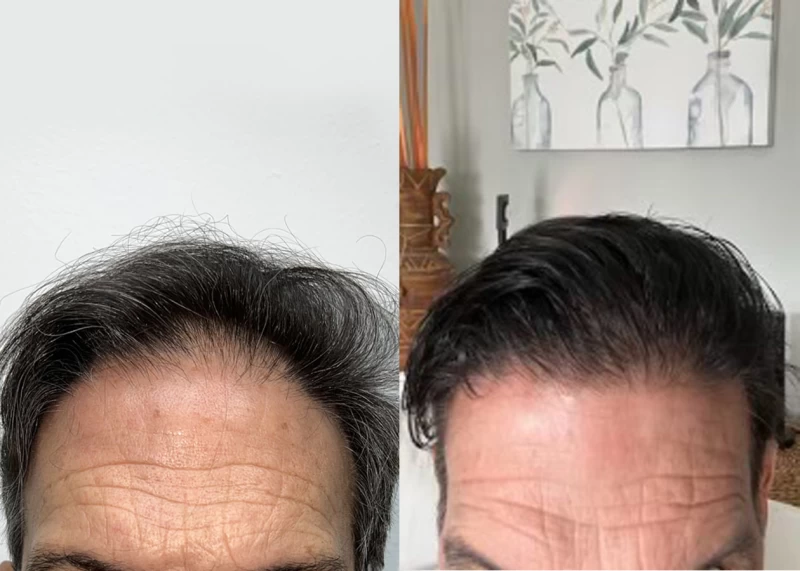 Patient 636 Hair Transplant Before and After