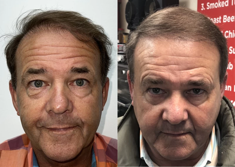 Patient 637 Hair Transplant Before and After