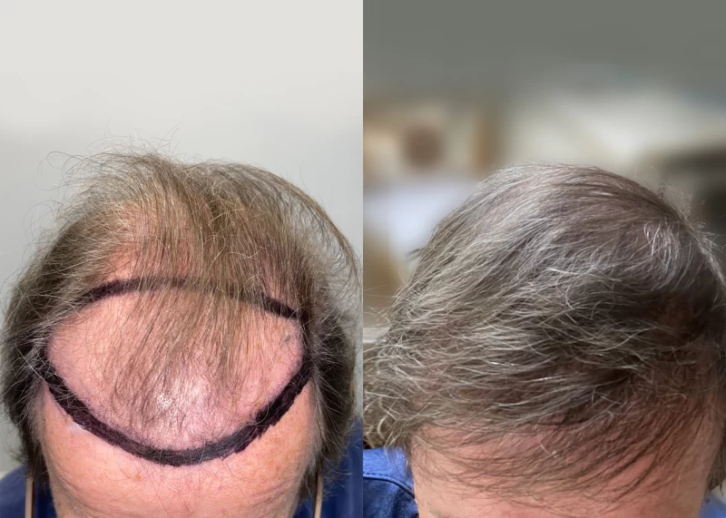 Patient 638 Hair Transplant Before and After