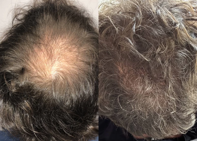 Patient p639 hair transplant before and after crown view