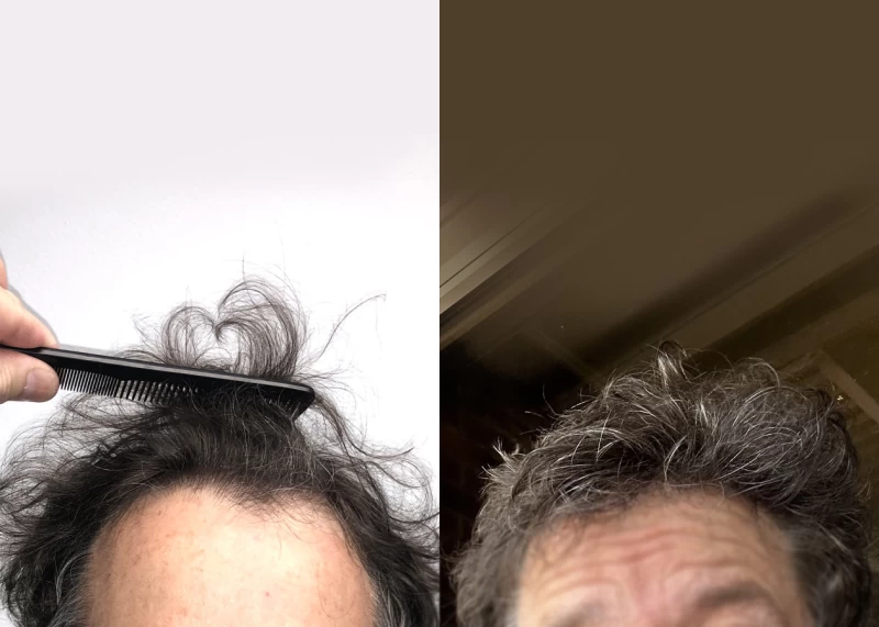 Patient 639 Hair Transplant Before and After