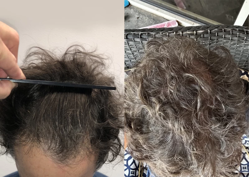 Patient p639 hair transplant before and after tilt view